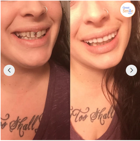Die perfekte Beauty-Lösung: Zahnschalen für Frontzähne, formbar für ein strahlendes Lächeln.