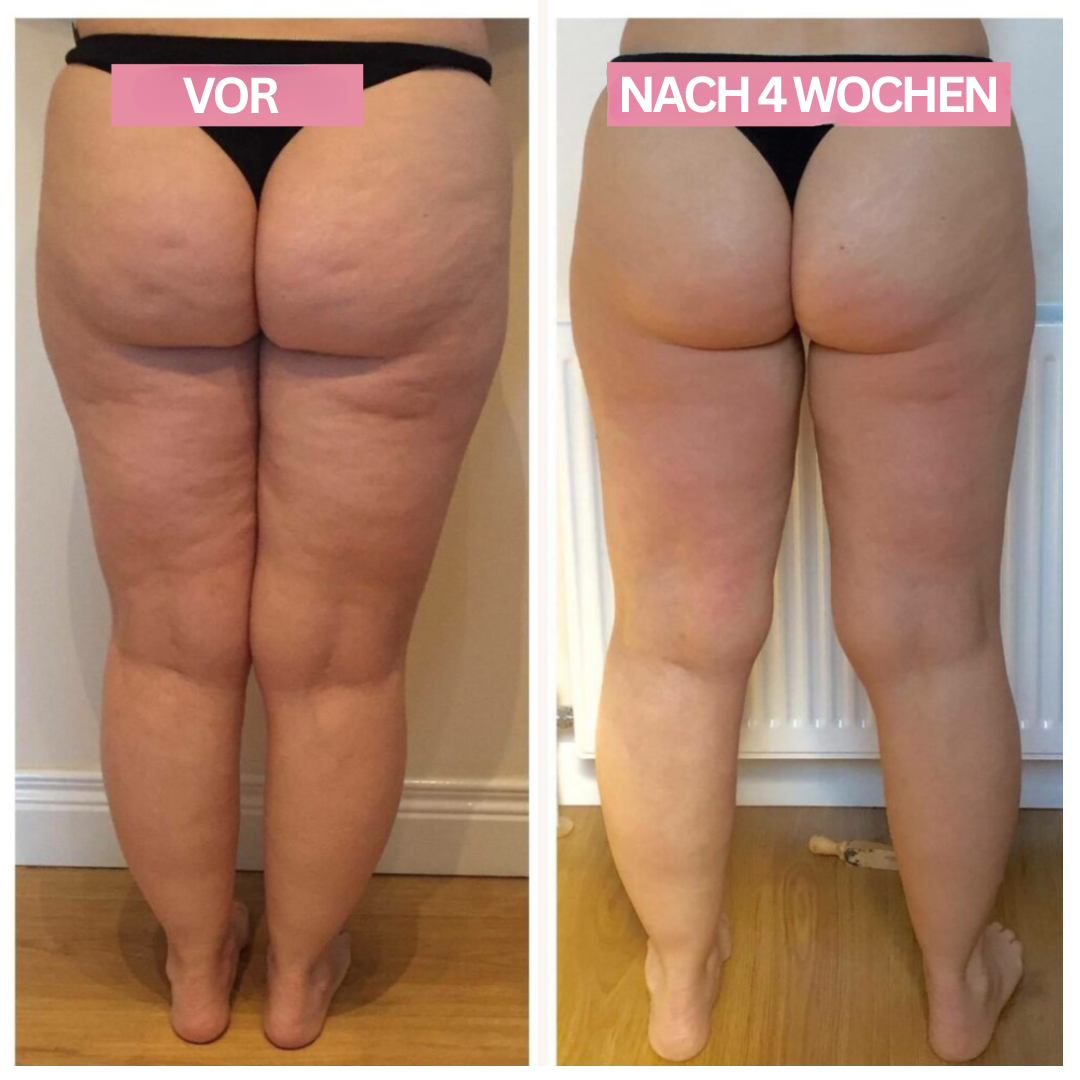 USB-wiederaufladbares Anti-Cellulite-Gerät mit Infrarotlicht & Cupping für einfache Hautpflege unterwegs.