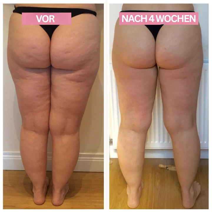 USB-wiederaufladbares Anti-Cellulite-Gerät mit Infrarotlicht & Cupping für einfache Hautpflege unterwegs.